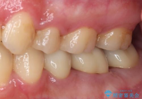 目立つ銀歯を白くしたい 奥歯のセラミック治療の治療後