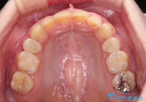 目立つ銀歯を白くしたい 奥歯のセラミック治療の治療後