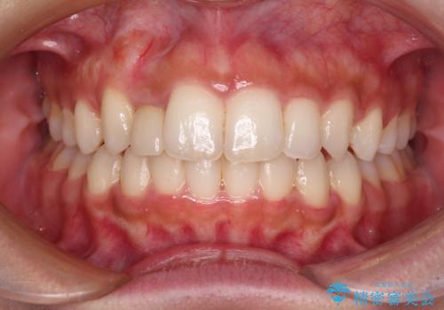 抜けてしまうと言われた前歯 インビザラインによる矯正治療の治療中