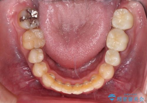目立つ銀歯を白くしたい 奥歯のセラミック治療の治療後