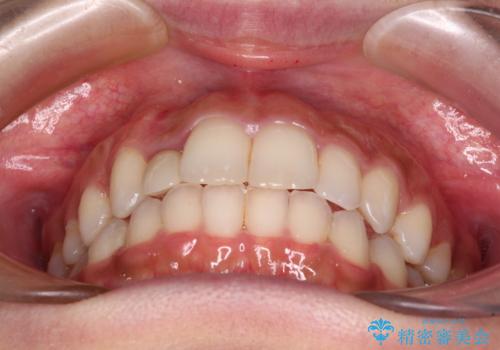 抜けてしまうと言われた前歯 インビザラインによる矯正治療の治療中