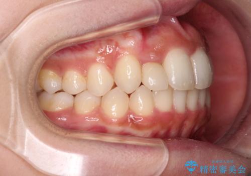 抜けてしまうと言われた前歯 インビザラインによる矯正治療の治療中