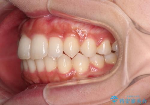 抜けてしまうと言われた前歯 インビザラインによる矯正治療の治療中