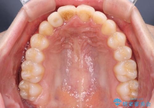 抜けてしまうと言われた前歯 インビザラインによる矯正治療の治療中