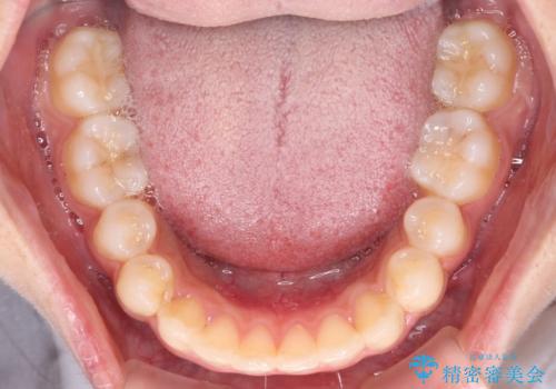 抜けてしまうと言われた前歯 インビザラインによる矯正治療の治療中