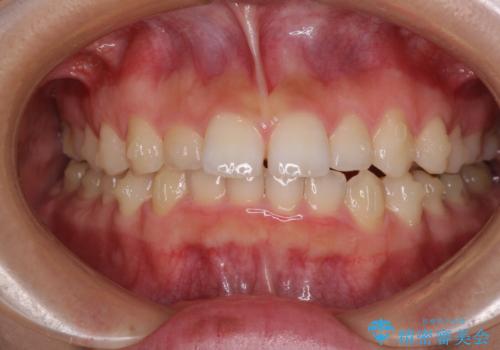 前歯のデコボコと突出感 インビザラインによる矯正治療の治療中