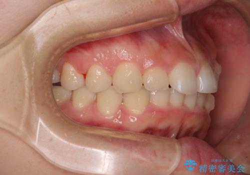 前歯のデコボコと突出感 インビザラインによる矯正治療の治療中