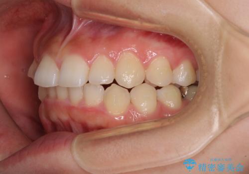 前歯のデコボコと突出感　インビザラインによる矯正治療の治療中