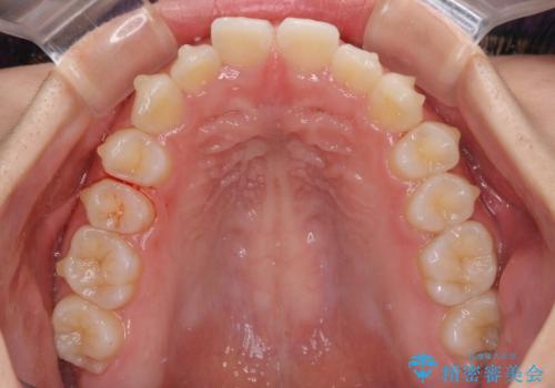 前歯のデコボコと突出感 インビザラインによる矯正治療の治療中