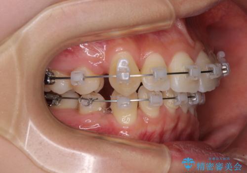 前歯の歯並びを治したい ワイヤー装置での抜歯矯正の治療中