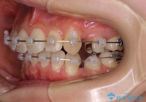 前歯の歯並びを治したい　ワイヤー装置での抜歯矯正の治療中