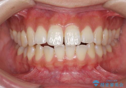 数ヶ月で、わずかな歯並びの修正に対応するインビザラインライト治療の治療前