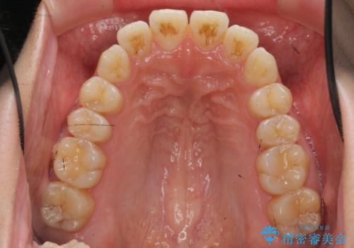 数ヶ月で、わずかな歯並びの修正に対応するインビザラインライト治療の治療前