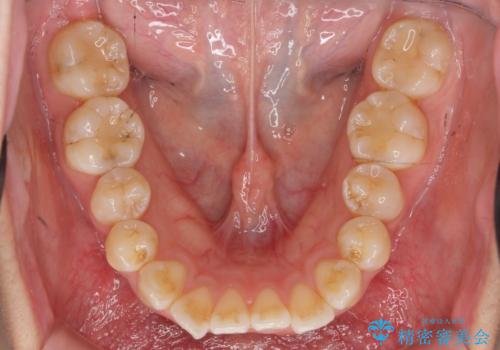 数ヶ月で、わずかな歯並びの修正に対応するインビザラインライト治療の治療前