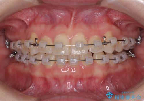 奥歯の欠損を放置 大臼歯を抜歯した矯正治療の治療中