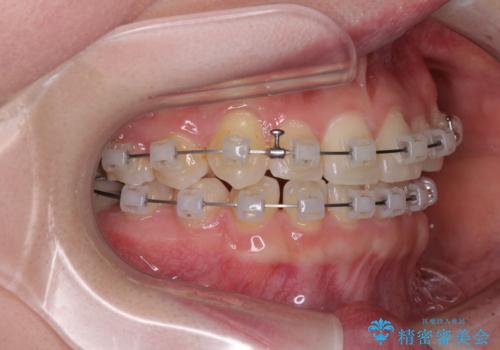 奥歯の欠損を放置　大臼歯を抜歯した矯正治療の治療中