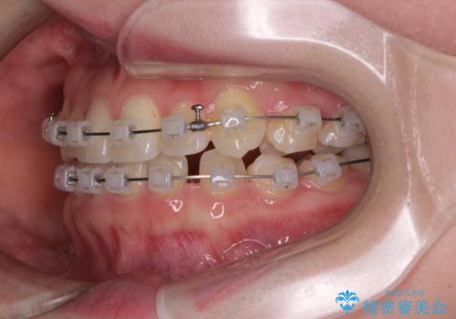 奥歯の欠損を放置 大臼歯を抜歯した矯正治療の治療中