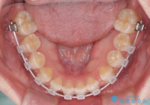 奥歯の欠損を放置 大臼歯を抜歯した矯正治療の治療中