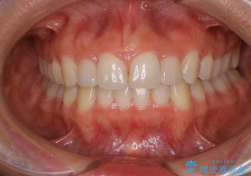 矮小歯を綺麗な歯に。矯正とセラミックの総合治療の治療後