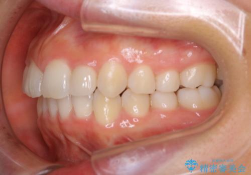 矮小歯を綺麗な歯に。矯正とセラミックの総合治療の治療後