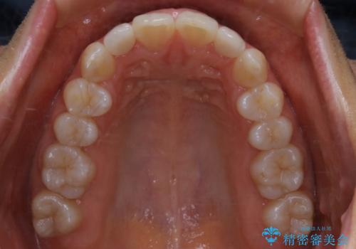 矮小歯を綺麗な歯に。矯正とセラミックの総合治療の治療後
