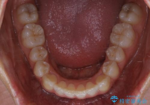 矮小歯を綺麗な歯に。矯正とセラミックの総合治療の治療後