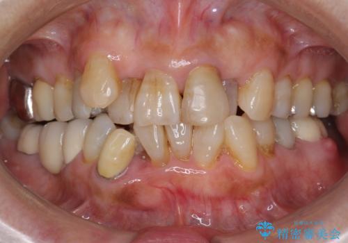 親知らずの移植 4年半経過症例 70代女性の治療前