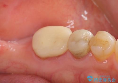 親知らずの移植 4年半経過症例 70代女性の治療前