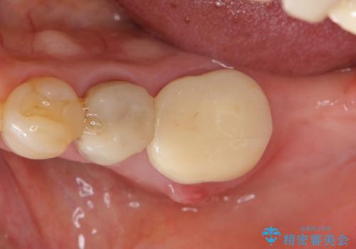 親知らずの移植 4年半経過症例 70代女性の治療前