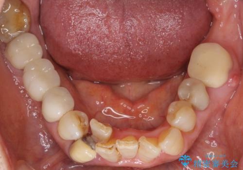 親知らずの移植 4年半経過症例 70代女性の治療前