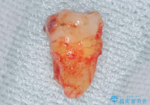 親知らずの移植 4年半経過症例 70代女性の治療前