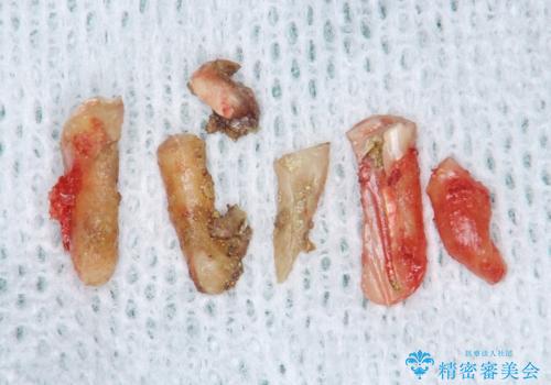 親知らずの移植 4年半経過症例 70代女性の治療後