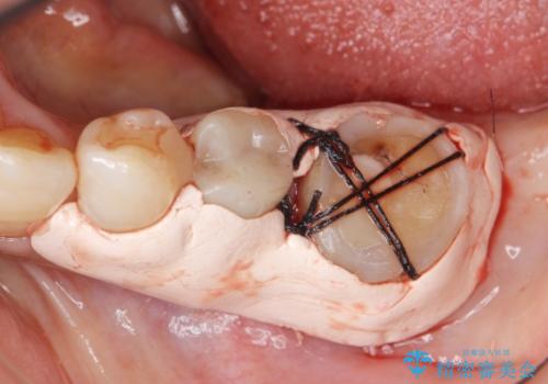 親知らずの移植 4年半経過症例 70代女性の治療中