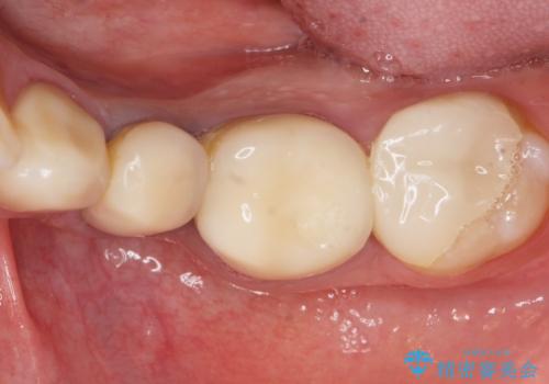 古い被せ物をセラミックにしたい 40代男性の治療前