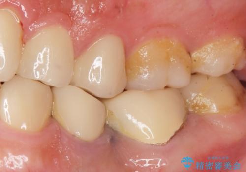 古い被せ物をセラミックにしたい 40代男性の治療前