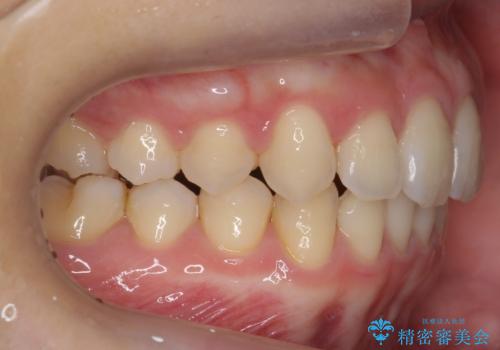 深いかみ合わせ 出っ歯の治療 インビザラインでの治療後