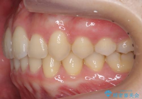深いかみ合わせ 出っ歯の治療 インビザラインでの治療後