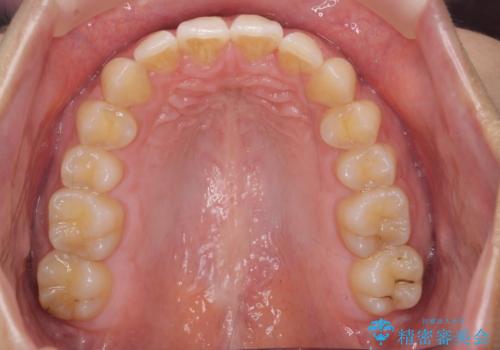 深いかみ合わせ 出っ歯の治療 インビザラインでの治療後