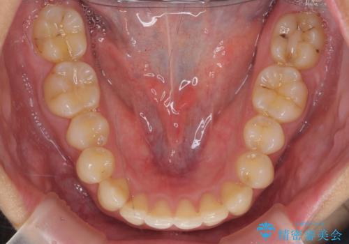 深いかみ合わせ 出っ歯の治療 インビザラインでの治療後
