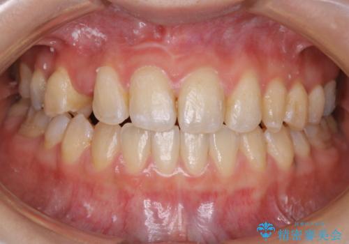 歯がないところに歯をつくる:矯正とセラミックの合わせ技で審美的な口元をの治療中