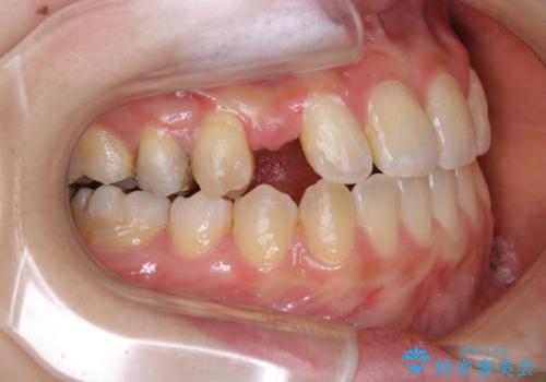 歯がないところに歯をつくる:矯正とセラミックの合わせ技で審美的な口元をの治療中