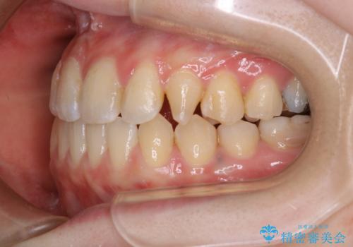 歯がないところに歯をつくる:矯正とセラミックの合わせ技で審美的な口元をの治療中