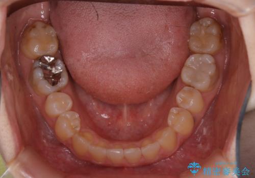 歯がないところに歯をつくる:矯正とセラミックの合わせ技で審美的な口元をの治療中