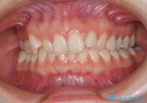 インビザライン単独では困難 補助装置を併用した矯正治療の治療前