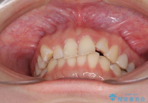 インビザライン単独では困難 補助装置を併用した矯正治療の治療前