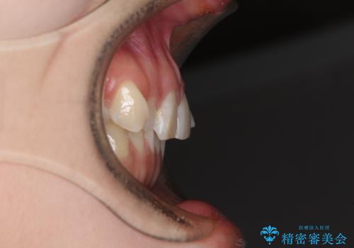 インビザライン単独では困難 補助装置を併用した矯正治療の治療前