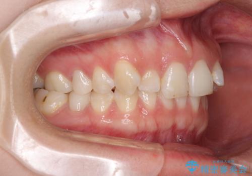 インビザライン単独では困難 補助装置を併用した矯正治療の治療前