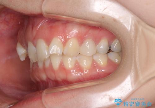 インビザライン単独では困難 補助装置を併用した矯正治療の治療前
