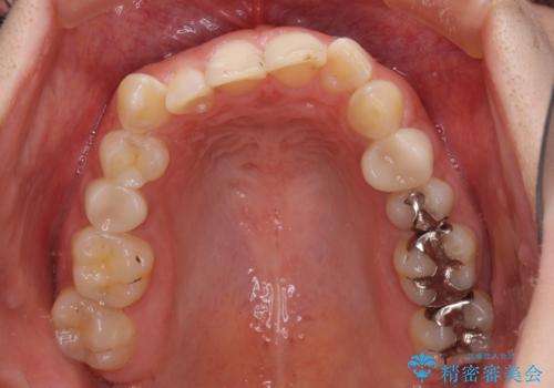インビザライン単独では困難 補助装置を併用した矯正治療の治療前