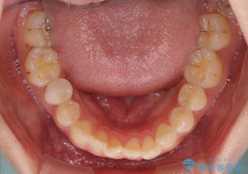 インビザライン単独では困難 補助装置を併用した矯正治療の治療前